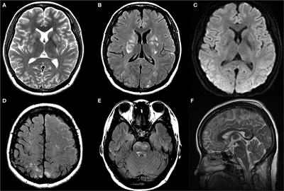 Cerebrospinal Fluid Hypovolemia and Posterior Reversible Encephalopathy Syndrome